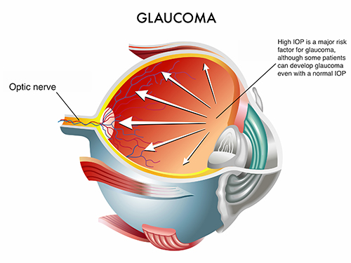 Glaucoma2