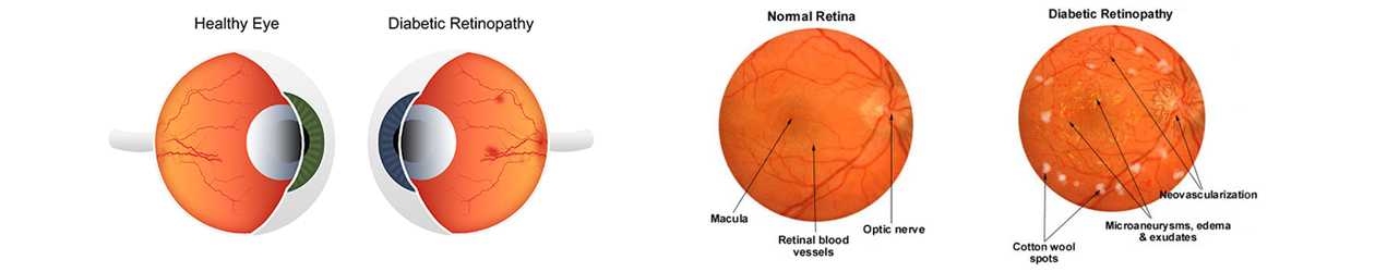 retinopathy-banner